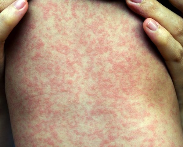 First Measles Case Reported In Bulgaria!